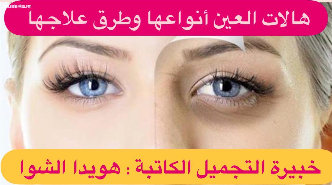 هالات العين أنواعها وطرق علاجها 