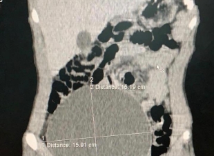 فريق طبي بمستشفى عفيف ينهي معاناة مريض من تورم في الجانب الأيمن للبطن